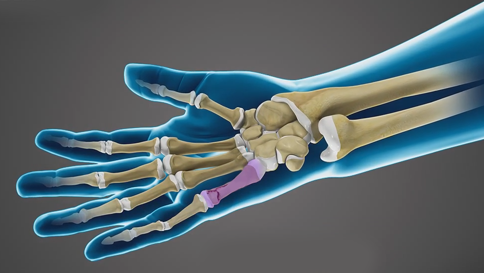 Fractures of the Hand and Fingers